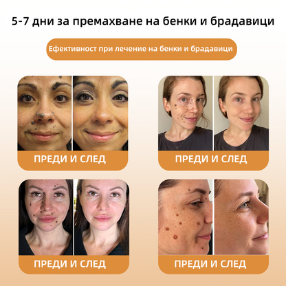 WREE™ крем за премахване на брадавици и кожни образувания с пчелна отрова❤️‍🔥(👨‍⚕Подходящ за всички типове кожа)🐝(🔥Последен ден на промоцията - 60% отстъпка)❤️‍🔥