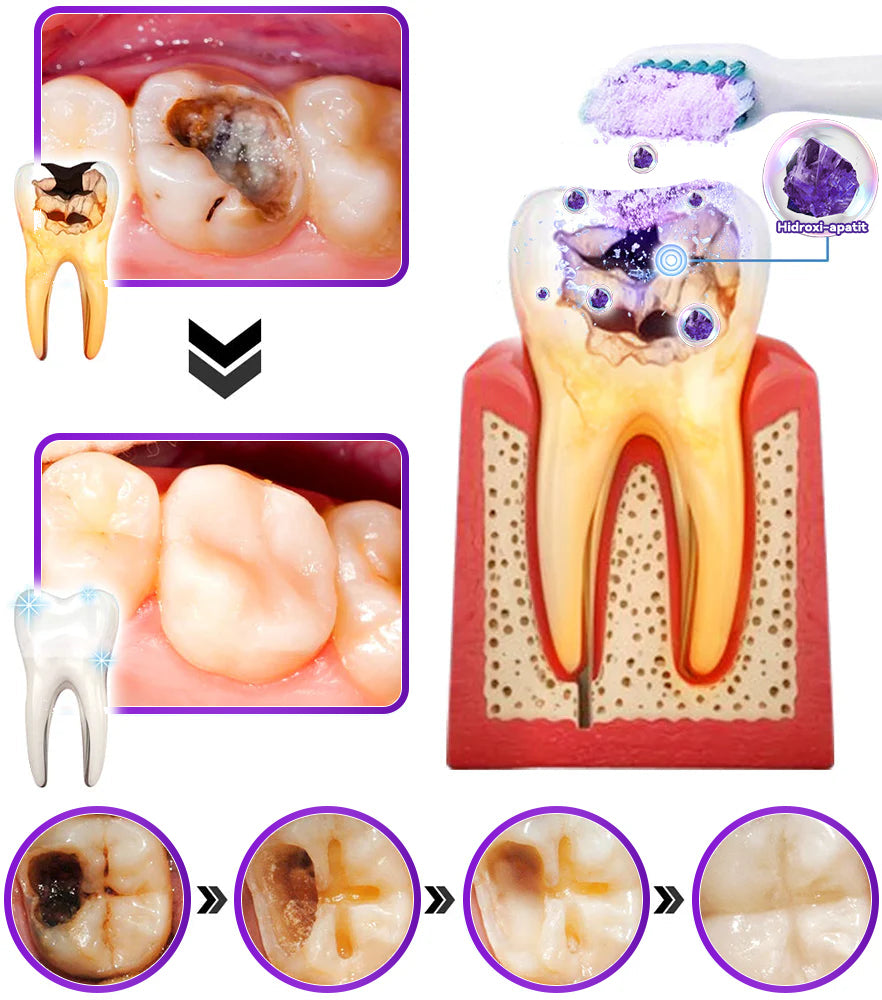 𝑫𝑜𝑟𝒎𝒐𝒓𝙣𝙖® Hidroxiapatit Foghelyreállitó Por👨‍⚕️Hatékonyan kezeli a szuvasodást, ínyproblémákat, érzékeny fogakat, szájüregi sebeket és sárga fogakat, miközben javítja az általános szájhigiéniát🎉