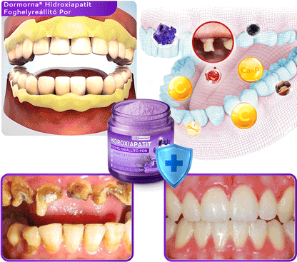 𝑫𝑜𝑟𝒎𝒐𝒓𝙣𝙖® Hidroxiapatit Foghelyreállitó Por👨‍⚕️Hatékonyan kezeli a szuvasodást, ínyproblémákat, érzékeny fogakat, szájüregi sebeket és sárga fogakat, miközben javítja az általános szájhigiéniát🎉
