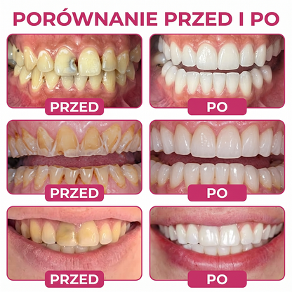 Rolimey® DenPerm – Naturalny żel wypełniający szkliwo do leczenia ubytków próchnicowych🧋