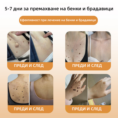 WREE™ крем за премахване на брадавици и кожни образувания с пчелна отрова❤️‍🔥(👨‍⚕Подходящ за всички типове кожа)🐝(🔥Последен ден на промоцията - 60% отстъпка)❤️‍🔥