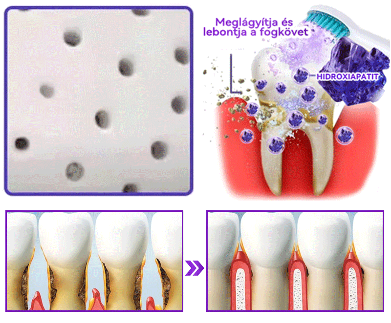 𝑫𝑜𝑟𝒎𝒐𝒓𝙣𝙖® Hidroxiapatit Foghelyreállitó Por👨‍⚕️Hatékonyan kezeli a szuvasodást, ínyproblémákat, érzékeny fogakat, szájüregi sebeket és sárga fogakat, miközben javítja az általános szájhigiéniát🎉