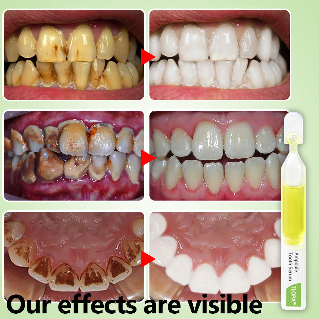 💎TLOPA™ Ampoule Toothpaste(for all kinds of dental problems, including cosmetic and rejuvenation)