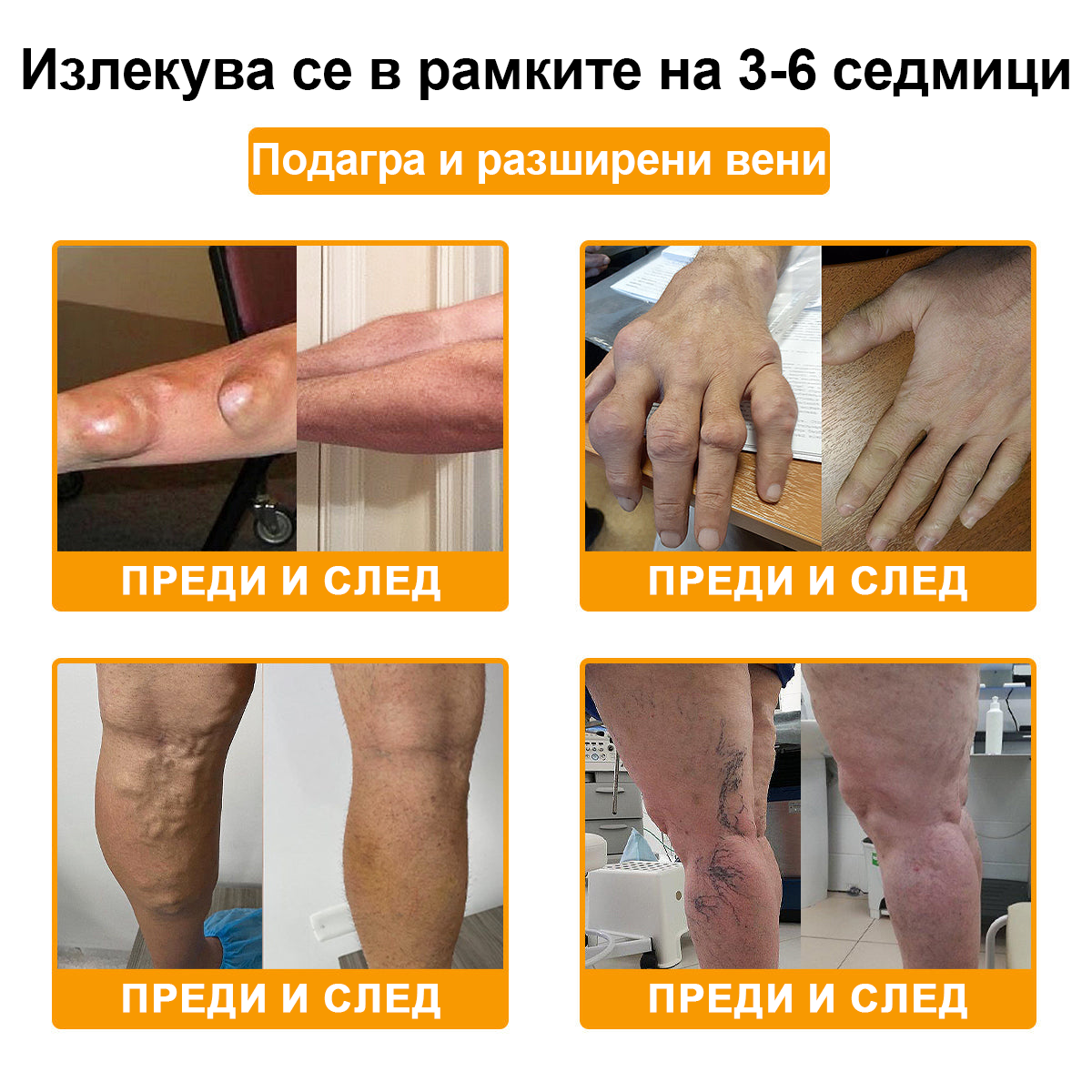 FATONG™ Крем за облекчаване на болката в костите с пчелна отрова (Специално за възрастни хора, препоръчван от Американската академия по ортопедична хирургия - AAOS)