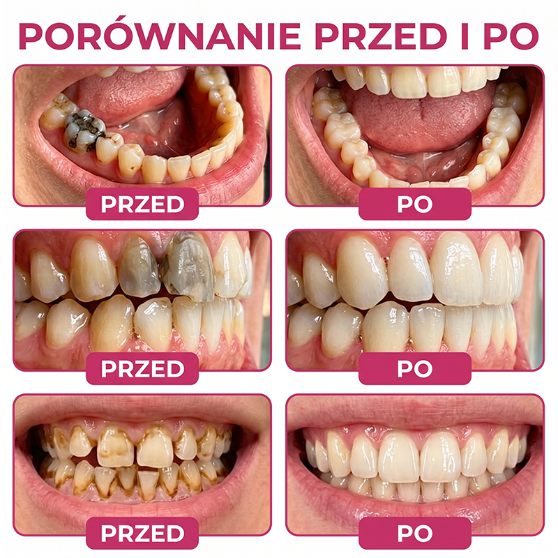 Rolimey® DenPerm – Naturalny żel wypełniający szkliwo do leczenia ubytków próchnicowych🧋